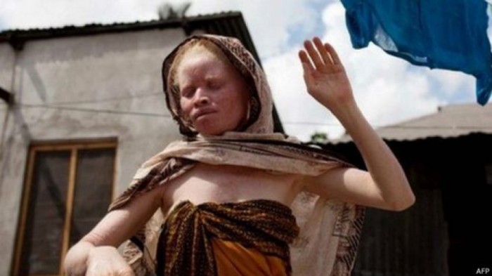 Cerca de 70 pessoas com albinismo vivem na ilha de Ukerewe