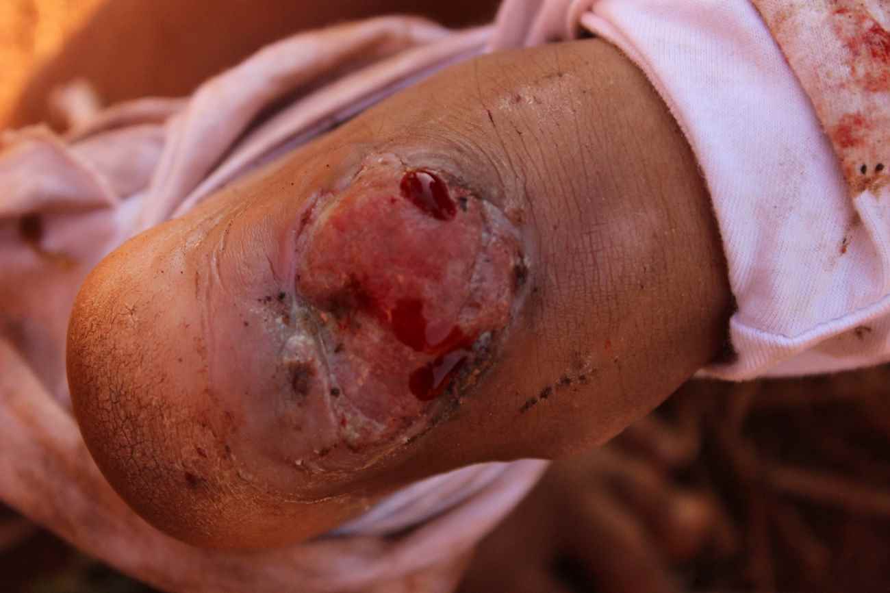 Ferida no pé de uma criança da Aldeia Pacurity, Dourados, MS. O menino ficou sem atendimento médico por mais de três meses. Foto: Eliel Benites, 2015.